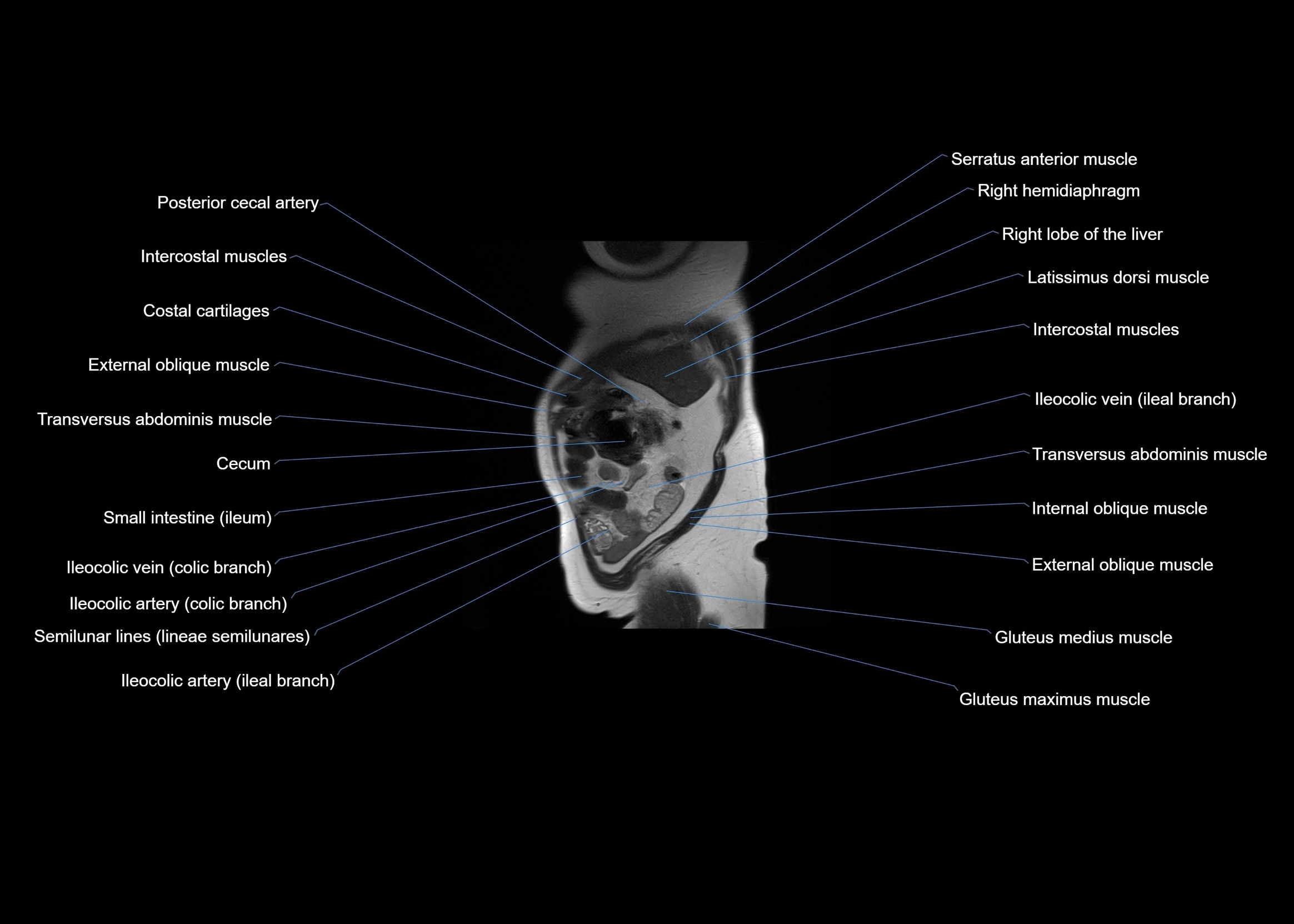 MRI abdomen sagittal cross sectional anatomy  radiology  image-img-00001-00010.webp